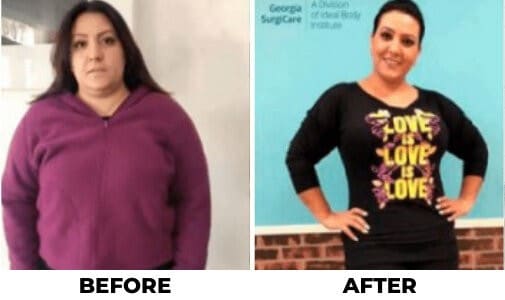 esg Tampa Weight Loss Procedures